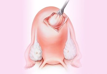 Sau khi mổ u xơ tử cung nên ăn gì để nhanh chóng hồi phục?